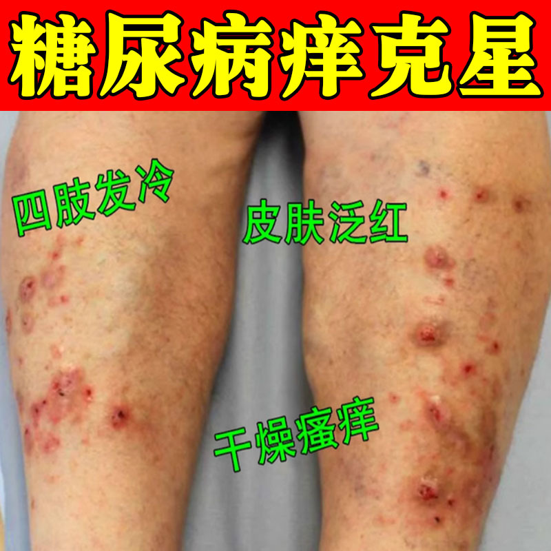 糖尿病皮肤痒血糖高引起皮肤瘙痒溃烂止痒膏腿上起红点红疙瘩痒