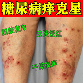 糖尿病皮肤痒血糖高引起皮肤瘙痒溃烂止痒膏腿上起红点红疙瘩痒