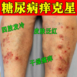糖尿病皮肤痒血糖高引起皮肤瘙痒溃烂止痒膏腿上起红点红疙瘩痒