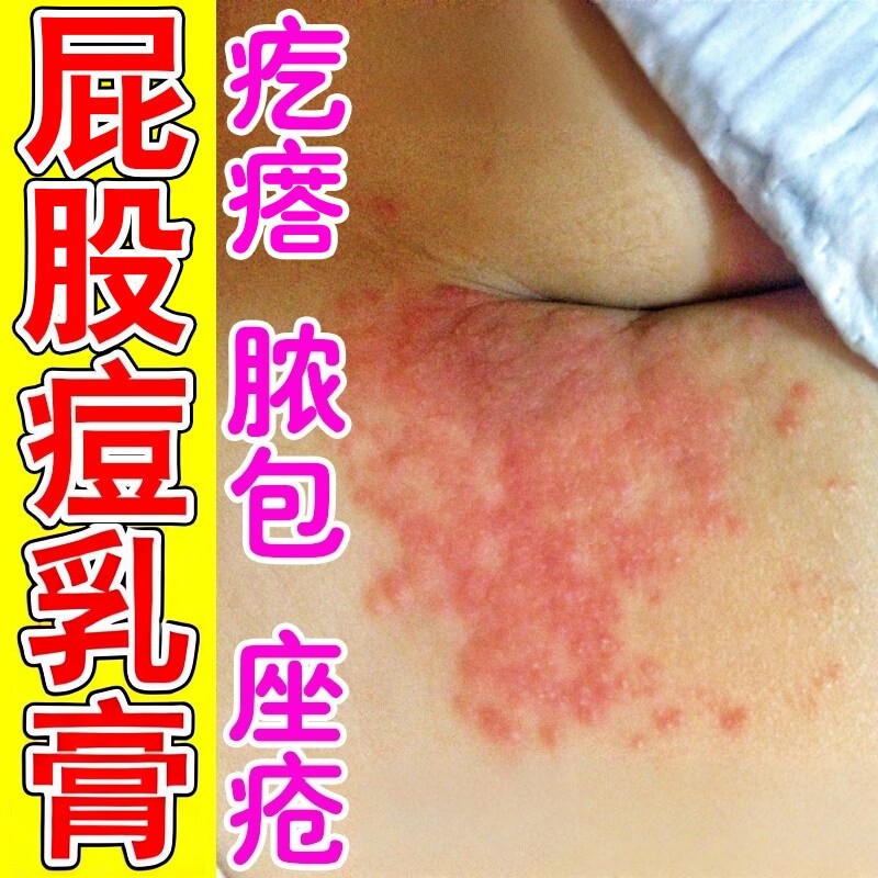 屁股上长痘痘痒毛囊痒火疖子拔脓膏屁股痒起红疙瘩长水泡坐板疮膏