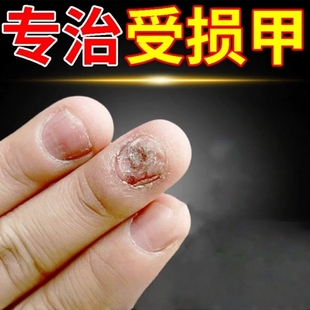 手指甲凹凸不平修复液甲床受损再生空甲浑浊真菌感染发黄增厚专用