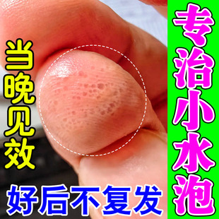 汗泡疱疹药膏克星手上起小水泡手上痒鹅掌风专用汗状疱疹止痒抑菌