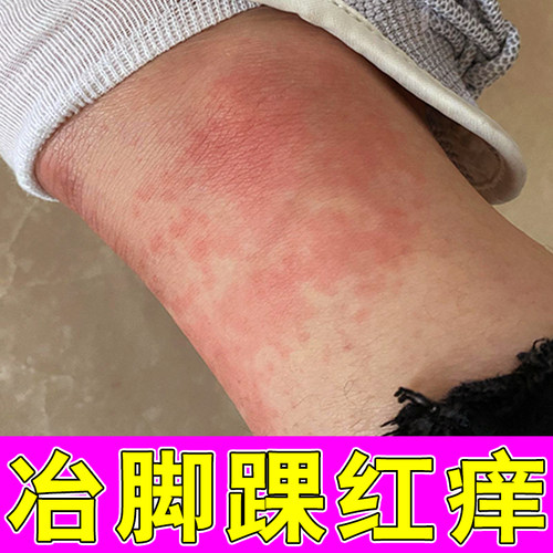 脚踝红肿发痒脚脖皮肤干燥粗糙红痒脚背起红疙瘩红点草本修护软膏