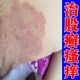 大腿内侧皮肤瘙痒根去男士 股藓私处真菌感染红疹疙瘩皮炎杀菌药