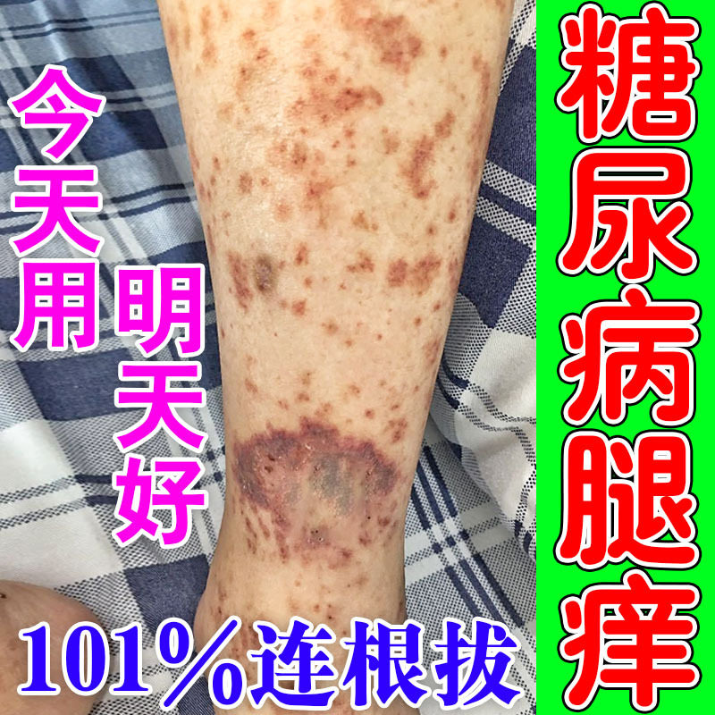糖尿病皮肤痒止痒膏老年人血糖高引起小腿瘙痒溃烂起疹子疙瘩专用
