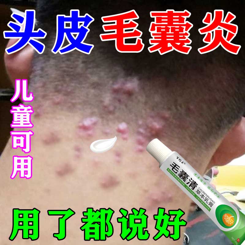 头皮毛囊焱专用膏头部脖子前胸后背私处长痘痘痒溢脂性毛囊藓乳膏