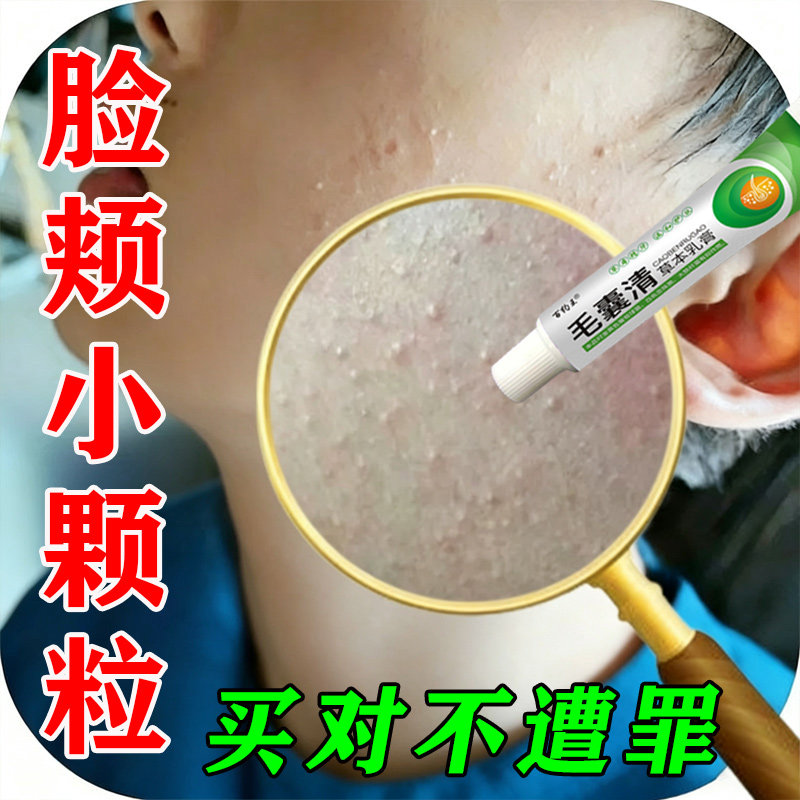 儿童毛周角化症膏去除脸部鸡皮肤脸上有小颗粒脸颊专用毛囊角质膏