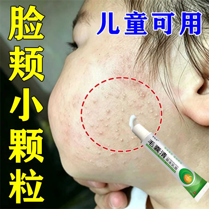儿童毛周角化症膏去除脸部鸡皮肤脸上有小颗粒脸颊专用毛囊角质膏