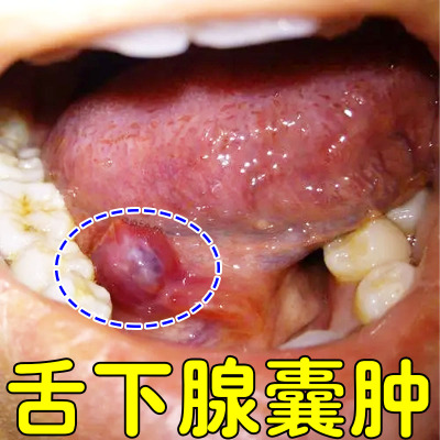 舌下腺囊肿专用喷剂舌根长疙瘩肿块有异物感口腔粘液腺囊肿息肉