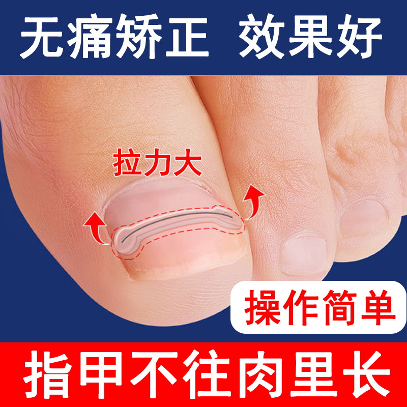 甲沟嵌甲矫正器炎正甲贴贴片脚趾指甲往肉里长专用指甲刀剪仿真贴