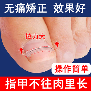 甲沟嵌甲矫正器炎正甲贴贴片脚趾指甲往肉里长专用指甲刀剪仿真贴