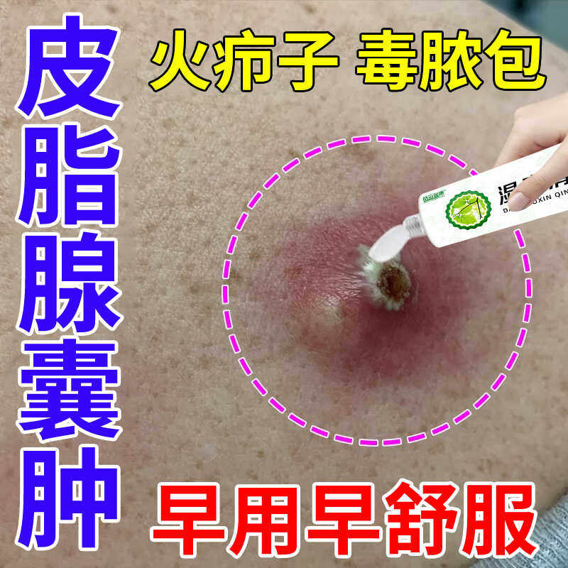 皮脂腺囊肿膏粉瘤去皮下纤维瘤火疖子屁股长痘痘坐疮疖肿拔毒膏
