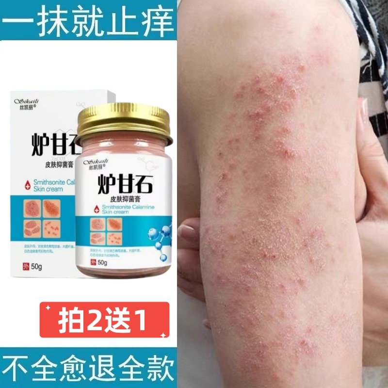 湿疹止痒去痒根外用顽固皮炎大腿内侧皮肤瘙痒癣痒专用膏抑菌药