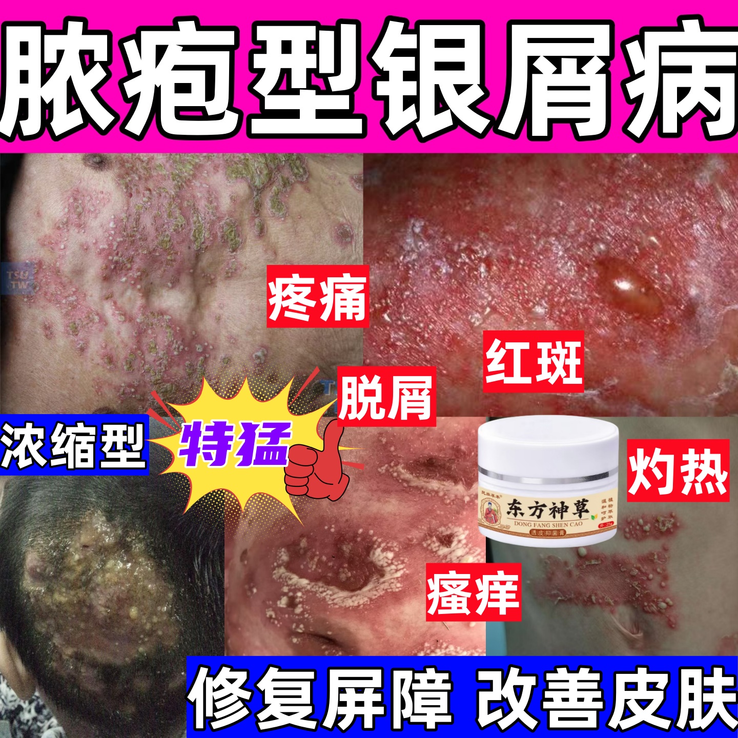 严重脓疱型银屑病牛皮血藓红斑脱屑疼痛瘙痒灼热头藓体股癣抑菌膏