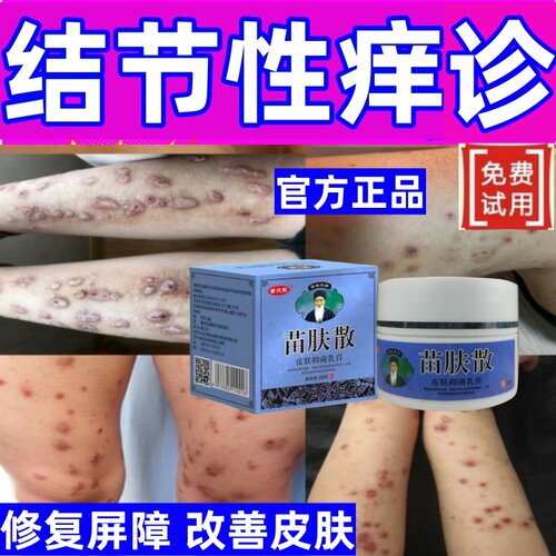 结节性痒疹湿疹皮肤病纯中药膏