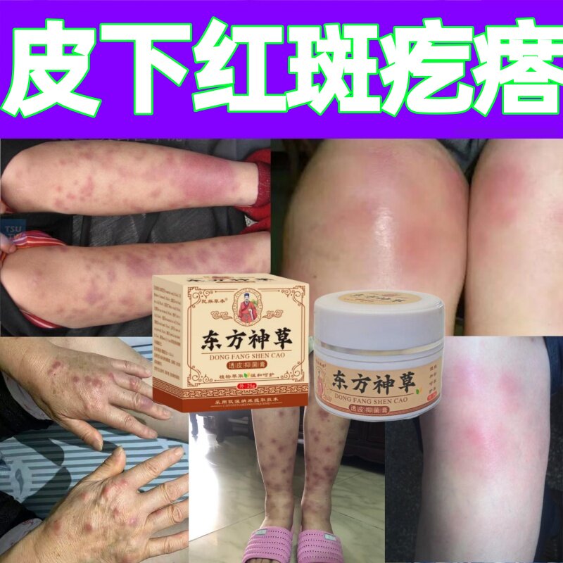 结节性红斑小腿下肢皮下疙瘩硬块红肿疼痛发热灼烧鼓包涂抹膏