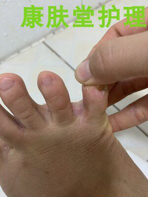 脚丫子烂了脚气黄铍医百多灵药膏抑菌止痒湿疹皮炎癣草本药膏