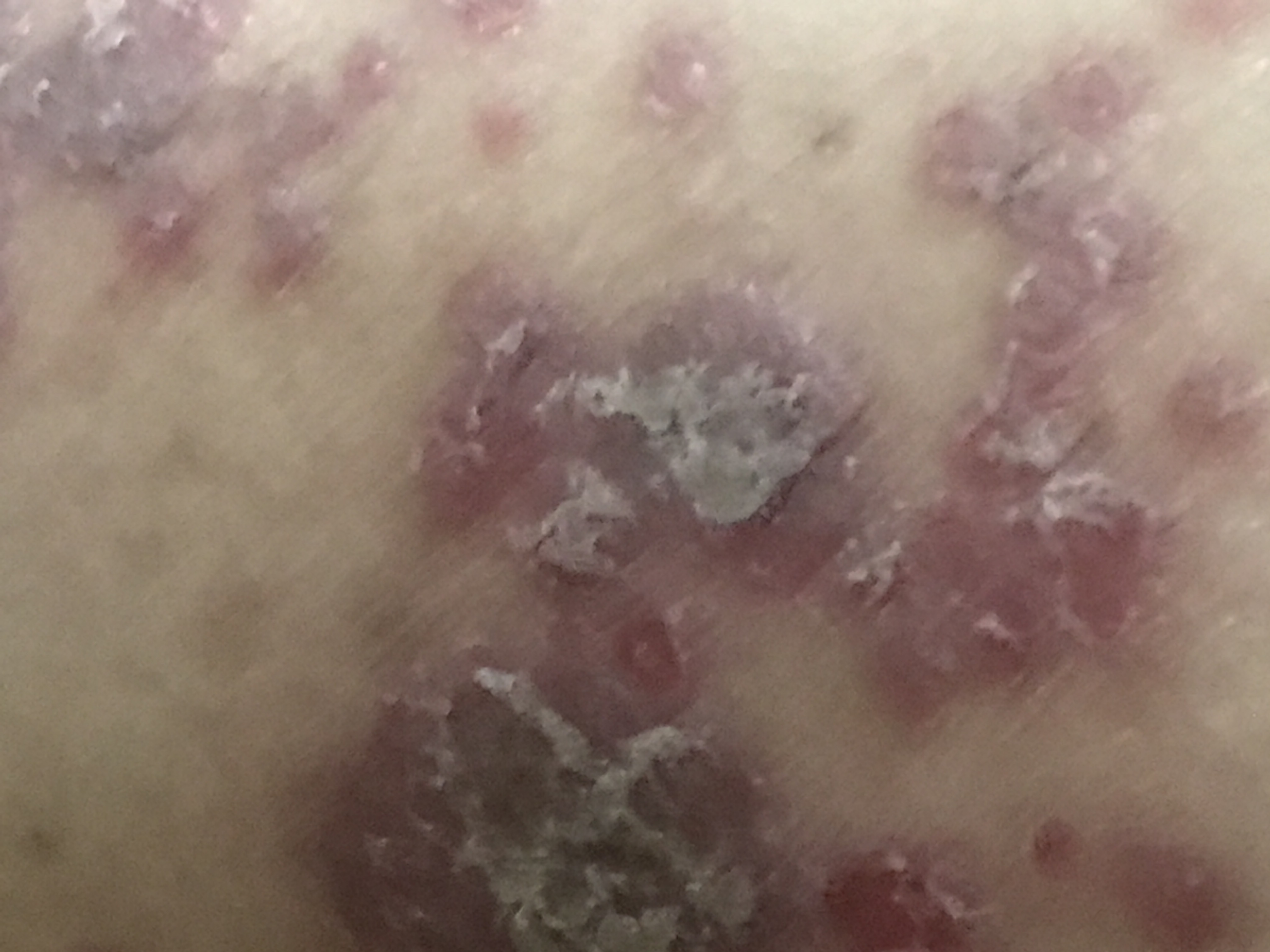 屁股疙瘩痘痘痒牛皮癣老赖铍痒立停草本抑菌药膏皮肤外用大腿根内