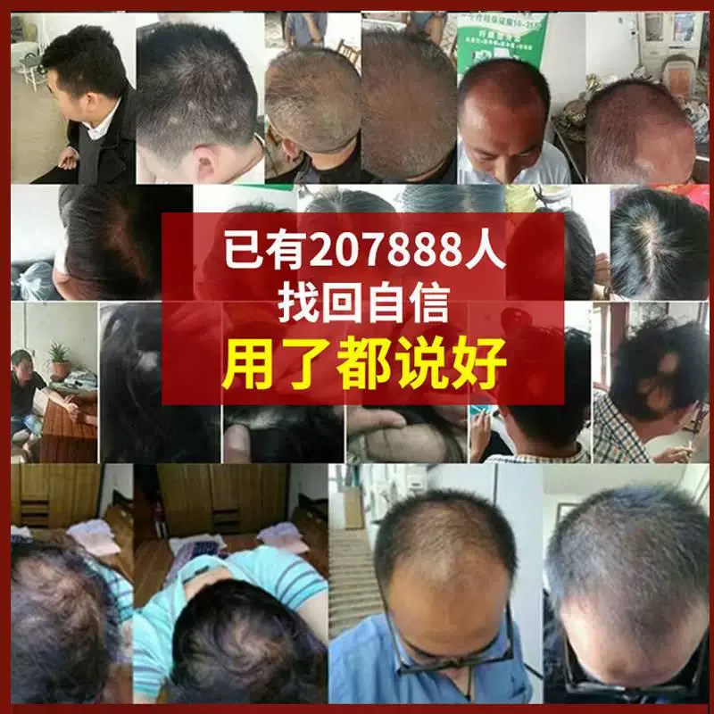生发丸九芝堂养发白发药物男士增发密发秃头斑秃防脱发药治疗图片