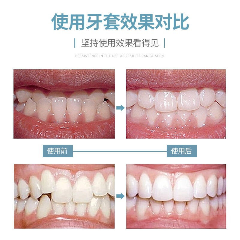 深覆e合纠正器突出矫正牙套夜用夜间防磨牙门牙保持器恢复中学生