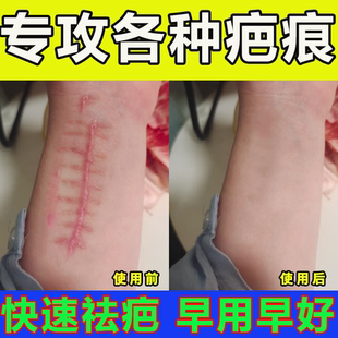 疤痕增生凸起去除胸前瘢痕疙瘩软化针修复油烫伤疤体质痒专用膏