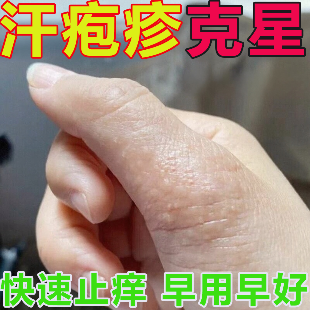 汗孢疹汗泡珍疱疹药膏专用汉状真菌感染手气手上起小水泡克星软膏