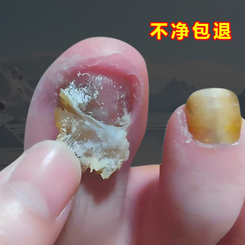 【同仁堂热卖10万+】不包不修 滴一滴无痛去除手脚趾坏钾不伤好钾