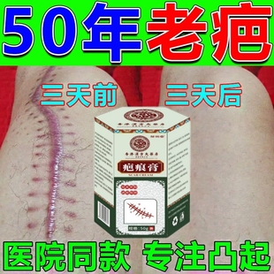 【香港老牌疤痕灵膏】闪电消除旧疤伤疤淡印凹凸增生痘坑去黑色素