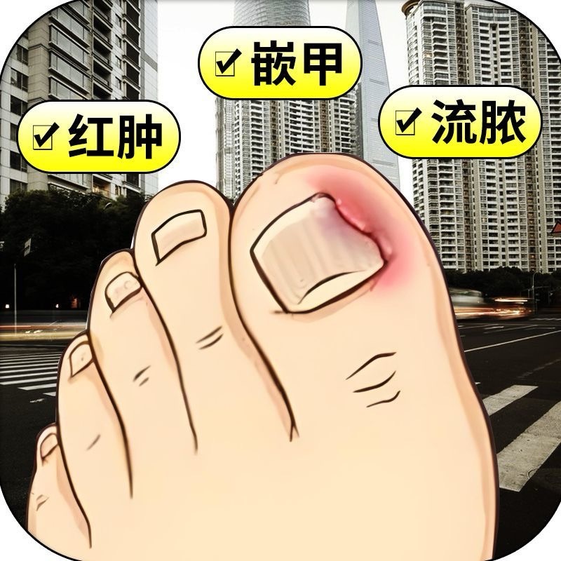 甲沟脚指甲疼大拇指往肉里长销肿感染发红肿化脓脚指甲止痛膏