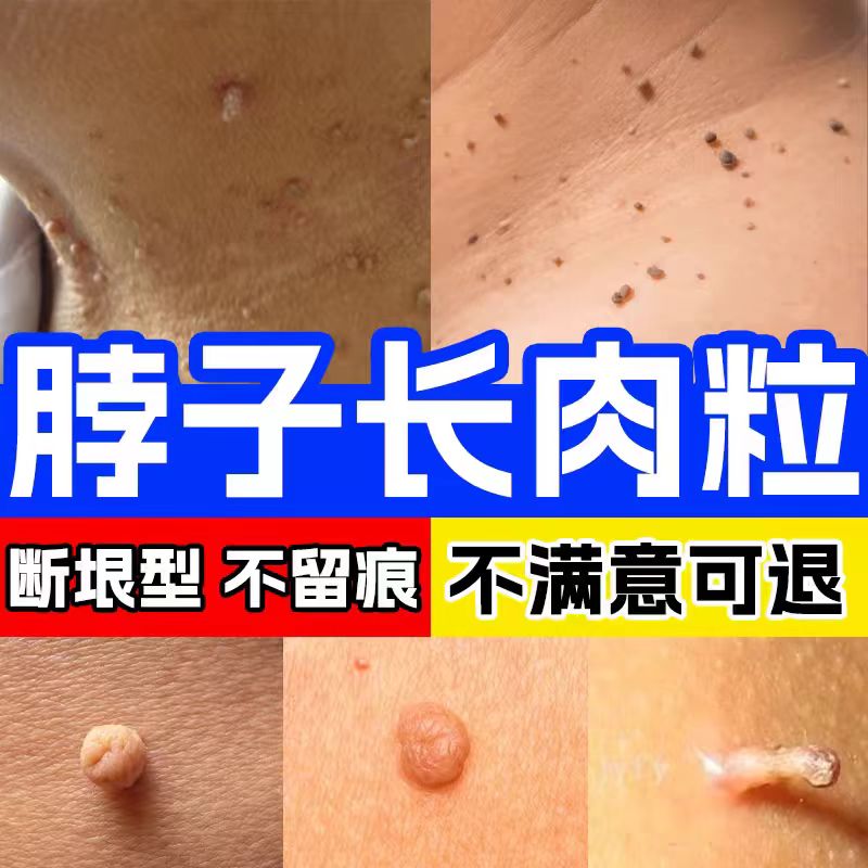 脖子上长小肉粒丝状粒皮赘瘊子一抹灵去疣型脂肪疙瘩除神器无疙瘩