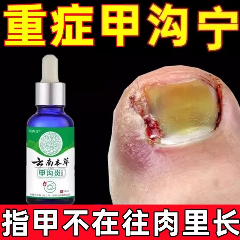 指甲长肉里治疗专用药特效药膏嵌甲克息肉去除脱指甲刀星液软化剂