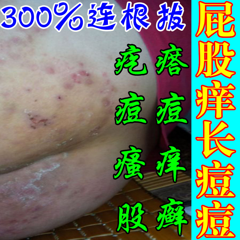 去久坐屁股上长痘痘起热疙瘩藓屁股沟干燥瘙痒出汗湿热红抑菌乳膏