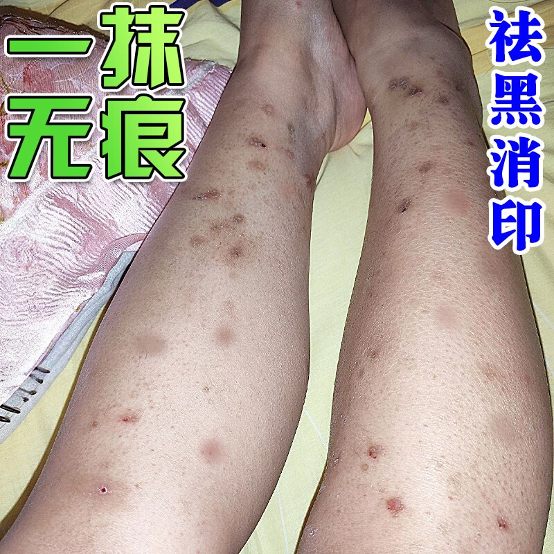 腿上挠印痘印伤烫疤痕蚊虫叮咬黑印淡化黑色素去沉淀去豆疤印消印
