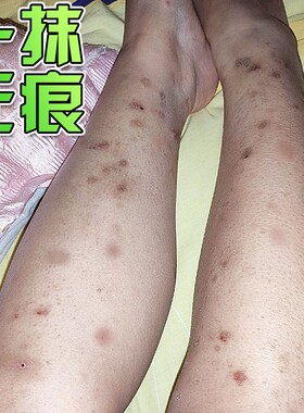 腿上挠印痘印伤烫疤痕蚊虫叮咬黑印淡化黑色素去沉淀去豆疤印消印