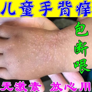 儿童手上起疙瘩痘痘过敏性皮炎湿 疹晒伤起红疹小红点手背痒药膏