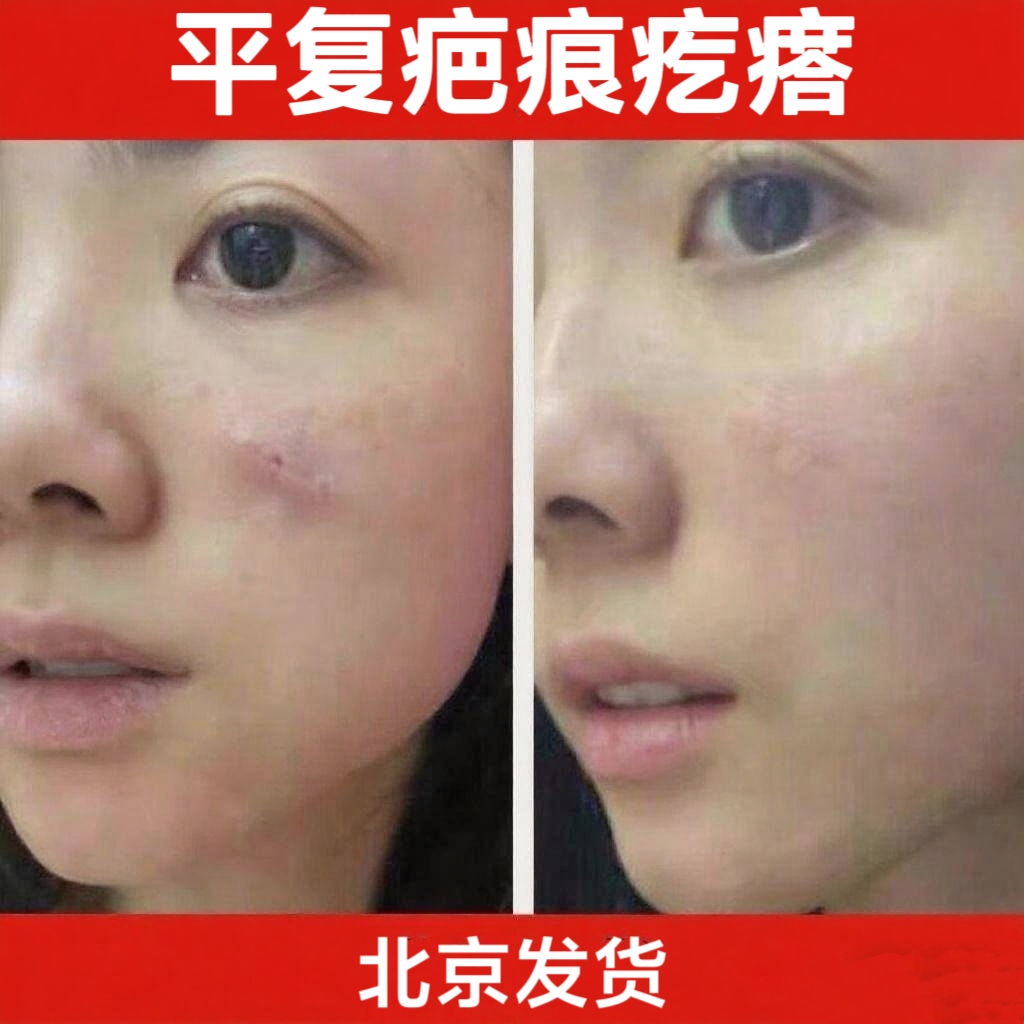 平复疤痕疙瘩增生黑布北京发货