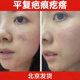 北京黑布疤痕膏胸口疙瘩凸起烫伤软化淡化平复疤痕体质