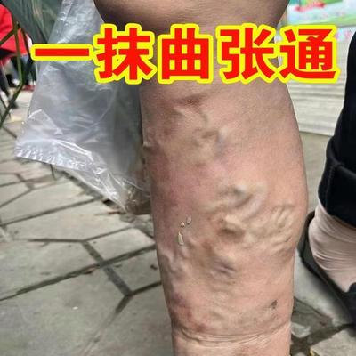 静脉曲张特效专用药膏青筋凸起专用药筋脉动脉治疗药