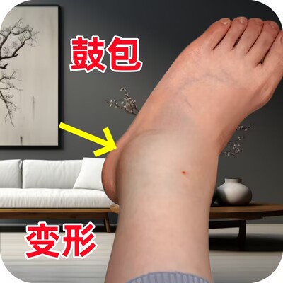 脚踝肿大疼痛专用鼓包骨裂陈旧老伤关节肿大韧带拉伤