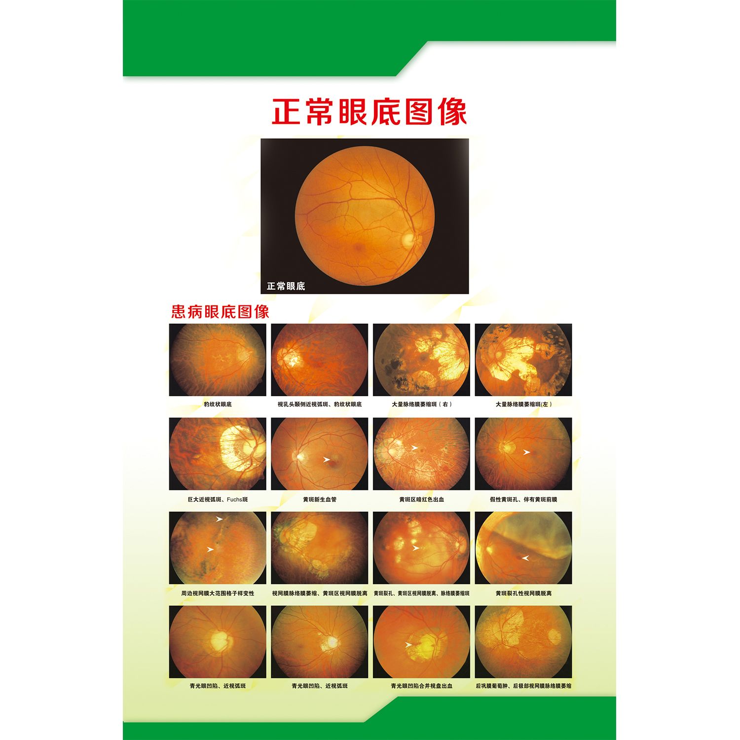 海报印制展板写真喷绘贴纸眼科常见眼底病变图墙贴KT板