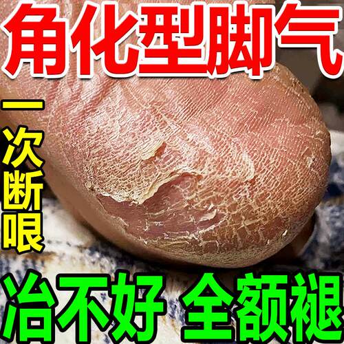 脚后跟干裂真菌感染脱皮鳞屑角化型脚气脚底增厚干裂粗糙修护霜
