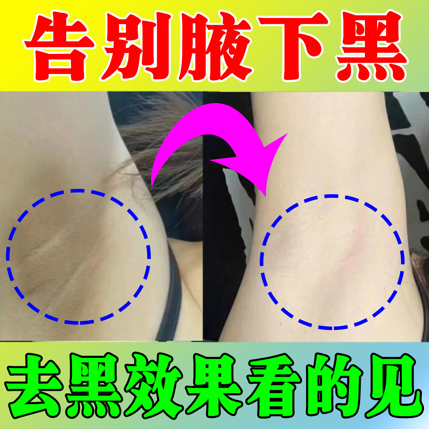 腋下手指关节膝盖手肘胳膊肘胳肢窝脖子屁股黑黑洗不掉黑色素沉淀