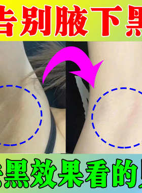 腋下手指关节膝盖手肘胳膊肘胳肢窝脖子屁股黑黑洗不掉黑色素沉淀