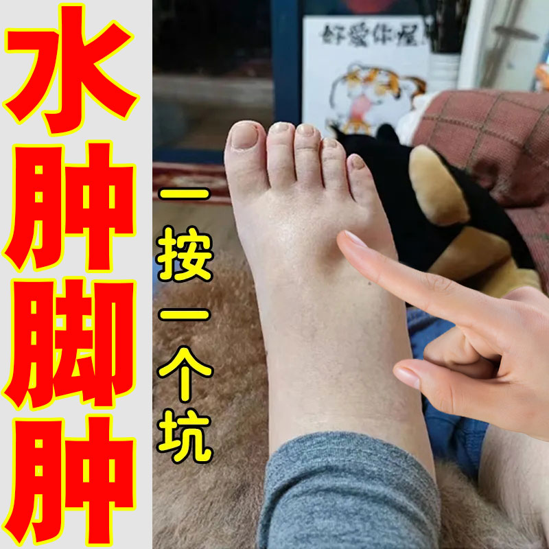 脚部小腿肿胀手脚面部浮肿疼痛缓解肩膀手臂小腿关节久站水肿喷剂