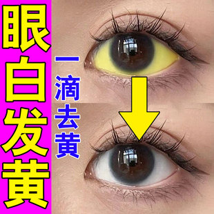 眼白发黄眼睛清澈去黄红血丝修复眼睛眼底黄斑干涩模糊护眼滴眼液