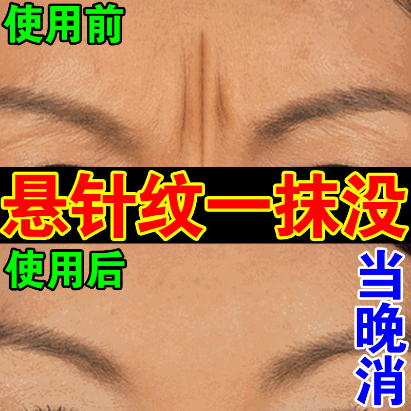 悬针纹去除神器眉间消川字纹去鱼尾纹紧致修复贴男女士凹陷填充针