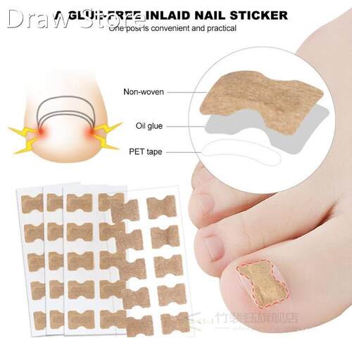 Ingrown Toenail Sticker Nail-Corrector Foot-Care Glue