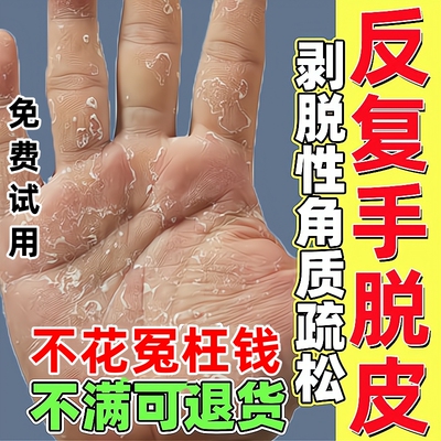 手足脱皮严重脱皮专用真菌蜕皮干燥起皮手指手掌脚底开裂的抑菌膏