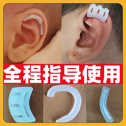 【效果很不错】宝宝耳朵矫正器