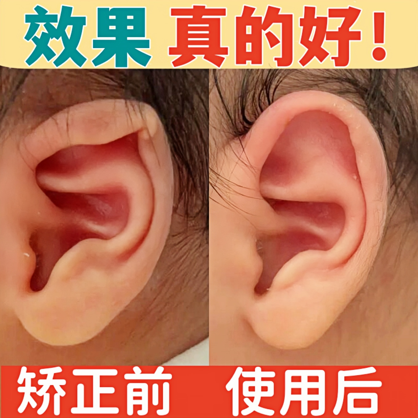 婴儿新生的儿招风耳垂耳耳夹耳贴耳撑耳型塑形耳朵耳廓固定矫正器